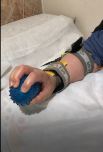 جریان تحریکی و تقویتی با هدف افزایش دامنه حرکتی خم شدن انگشتان بعد از شکستگی مچ به دنبال زمین خوردن...